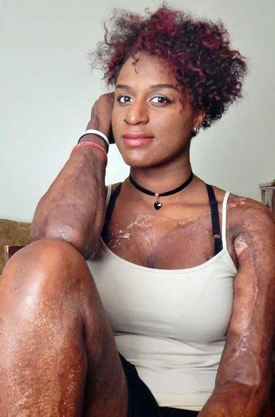 Photos Doctors Patch Burn Victim’s Skin With Dead People’s Flesh After 3rd Degree