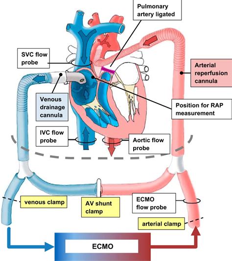 Right Atrial Pressure And Venous Return During Cardiopulmonary Bypass