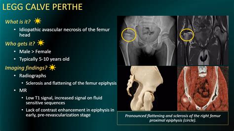 Cincy Kids Radiology On Twitter Osteochondromas Are Bony Excrescences