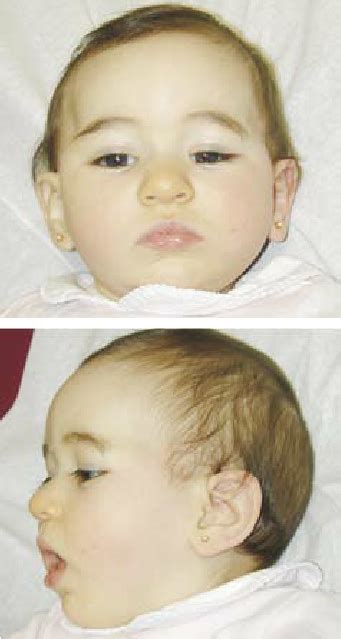 Front And Side Views Of The Patient At 10 Month Age Revealed Bilateral