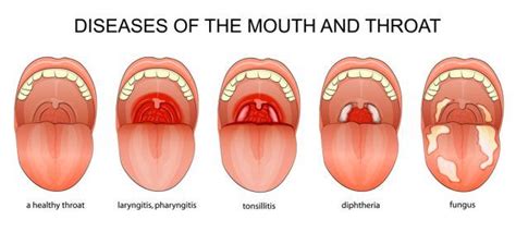 Causes For A Sore Throat What Causes A Sore Throat There Are A Few