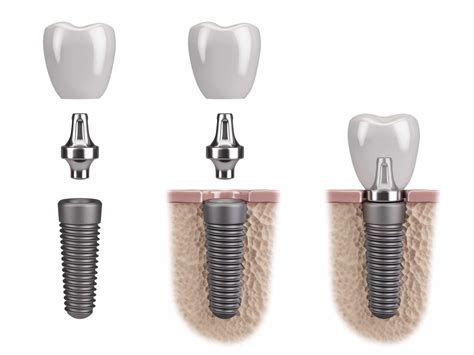 Livonia Dentist Looks At The Different Parts Of A Dental Implant Dr