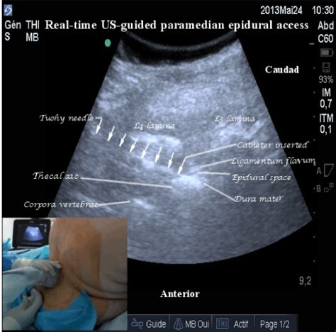 Real Time Ultrasound Guided Epidural Catheter Placement In Morbidly