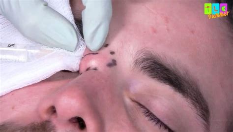 Exclusive Dr Pimple Popper Circles In On Anthonys Enormous Eye Cyst In Triangle Of Death