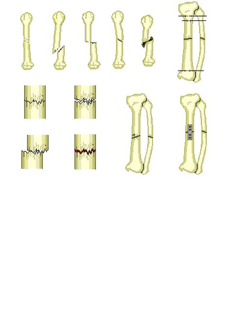 Backbone is most important part of a system which provides the central support to the rest system, for example backbone of a human body that balance and hold all the body parts. Types of Bone Fractures | Interactive Anatomy Guide