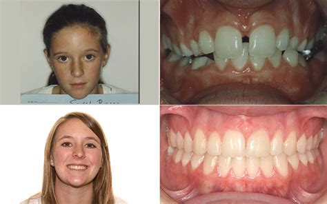 Braces Before And After