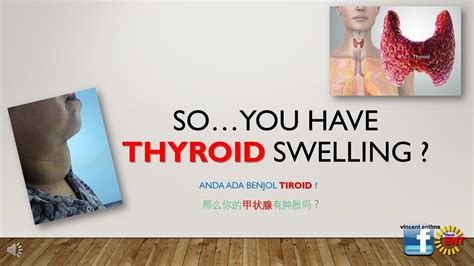 So You Think Your Neck Swelling Is A Thyroid Swelling Youtube