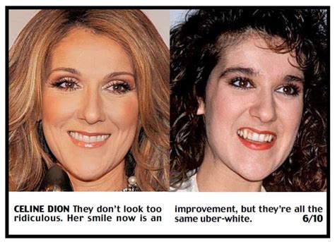 Cheryl Cole To Tulisa Veneered Whiter Than White Teeth Are Everywhere Daily Mail Online