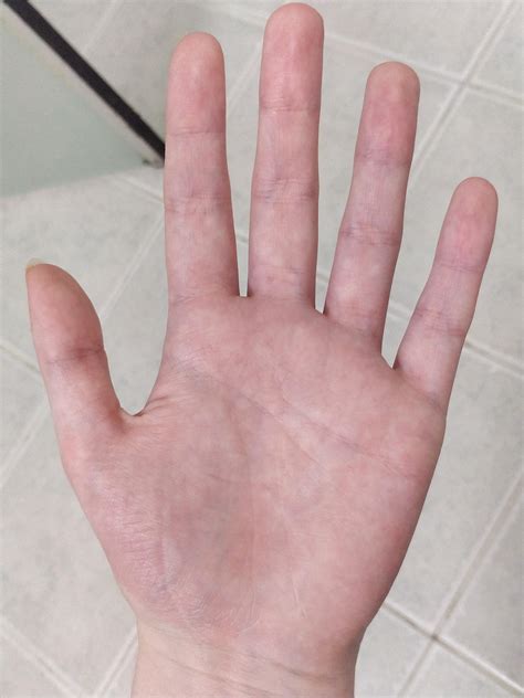 Do Your Hands Become Blotchy Like Mine My Veins Are Also Much More