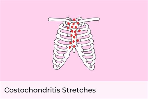 Costochondritis Stretches Exercises To Relieve Chest Pain