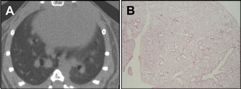 Effectiveness Of Rosiglitazone On Bleomycin Induced Lung Fibrosis