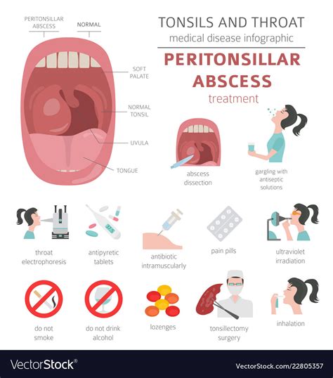 Tonsils And Throat Diseases Peritonsillar Abscess Vector Image