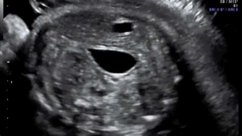 A New Sonographic Clue To The Antenatal Diagnosis Of Right Sided