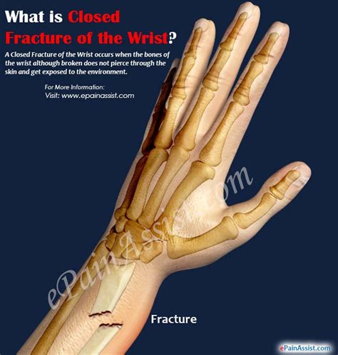 What Is Closed Fracture Of The Wrist Know Its Treatment Recovery