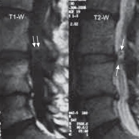 Axial T2 Weighted Mri Milimetric Left Anterior Synovial Cyst Under