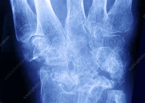 Rheumatoid arthritis is a type of chronic (ongoing) arthritis that occurs in joints on both sides of the body (for instance, both hands, wrists, and/or knees). Rheumatoid arthritis, x-ray - Stock Image - C004/0340 ...