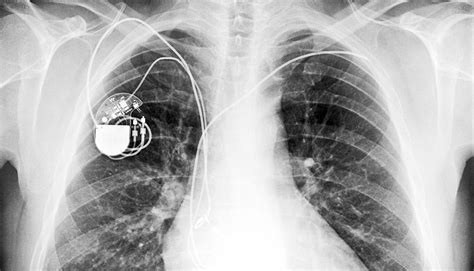 Pacemaker Types By X Ray