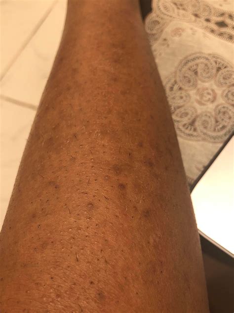 Routine Help Hyperpigmentation And Ingrown Hair On My Legs