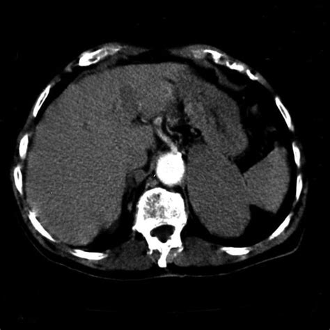 Ct Scan Showing Left Adrenal Gland Tumor 10 Cm In Diameter Having