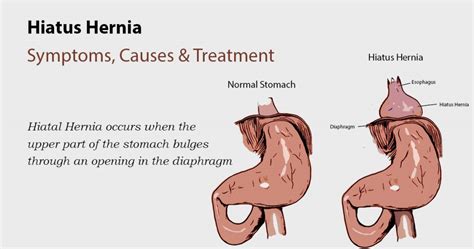 Hiatal Hernia Hiatus Hernia Symptoms Causes And Treatment The Best