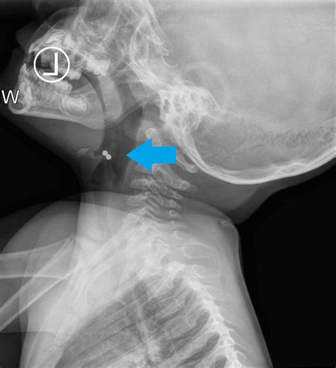 Normal Epiglottis X Ray