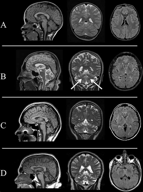 Mri Representative Brain Mri Findings In Sca 14 Patients Brain Mri