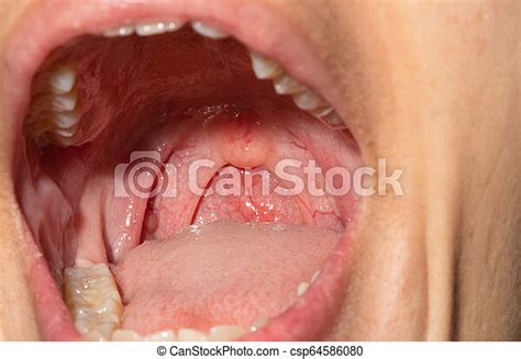 Sore Throat With Throat Swollen Closeup Open Mouth With Posterior