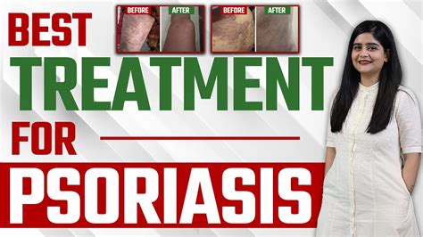 Best Treatment For Psoriasis सोरायसिस हुआ जड़ से खत्म Dr Health
