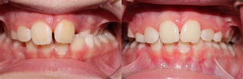 Treatment time depends on how severe your crossbite is. Early Treatment With Braces