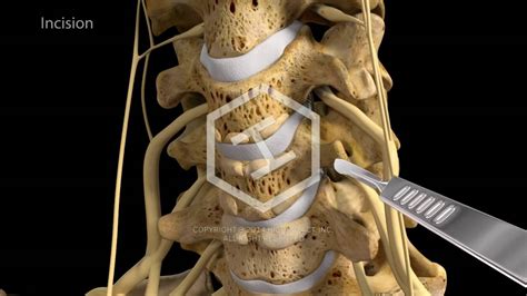 C5 C6 C7 Anterior Cervical Discectomy With Fusion Youtube