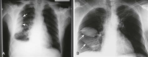 Pleural effusion (transudate or exudate) is an accumulation of fluid in the chest or on the lung. Thoracentesis | Anesthesia Key