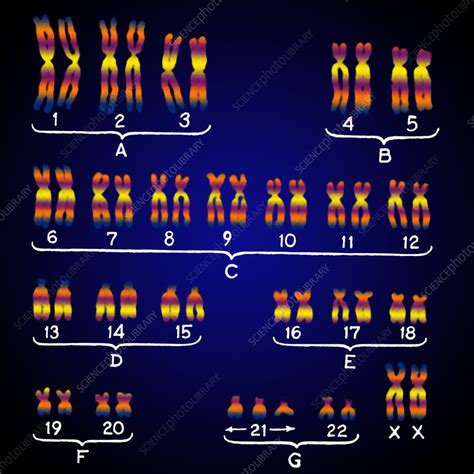 Female Karyotype Showing Downs Syndrome Stock Image C0219838 Science Photo Library