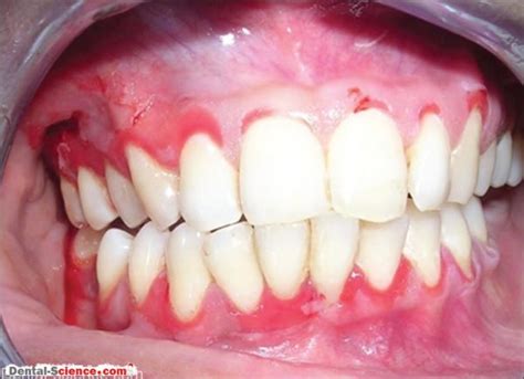 Desquamative Gingivitis Causes Signs Diagnosis And Management