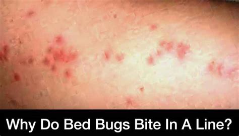 Bed Bugs Bite In A Straight Line 5 Things You Should Know