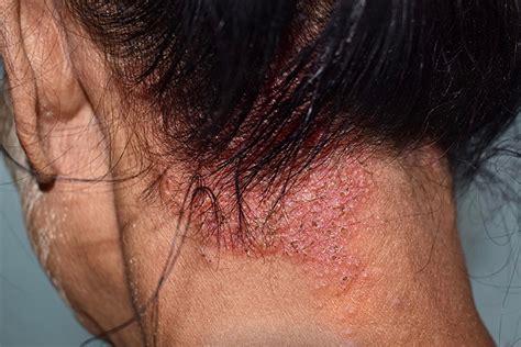 Dermatitis Seborreica Síntomas Y Tratamiento De Esta Enfermedad Fast
