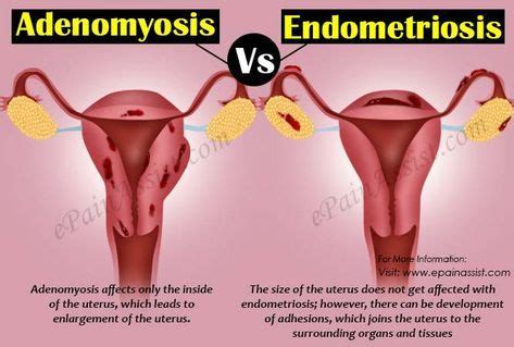 Ovarian cancer is a cancer that forms in or on an ovary. Adenomyosis vs. Endometriosis | Endometriosis, Adenomyosis ...