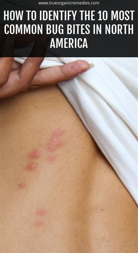 How To Identify The 10 Most Common Bug Bites In North America Bug
