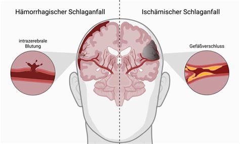 Schlaganfall Doccheck Flexikon