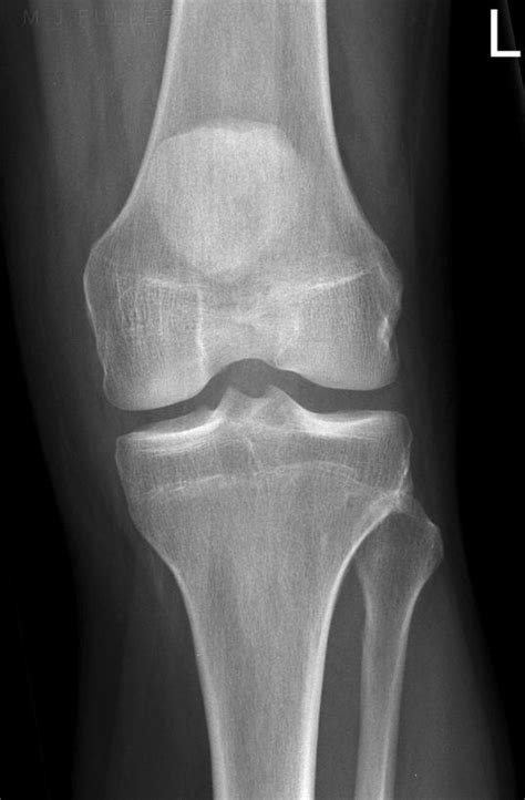 Knee Joint X Ray Anatomy