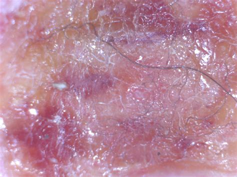 Morgellons Disease Is Not A Delusion Says New Study