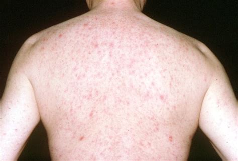 Common Cutaneous Complications In Hiv Positive Patients