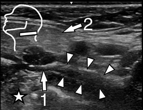 Ultrasound Of The Hypoglossal Nerve In The Neck Visualization And