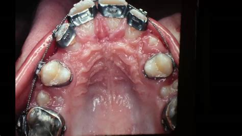 Broken Down Molar Extraction In Orthodontics Youtube