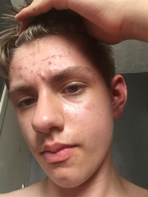 Thats not grease thats sweat from working. Acne is the worst : acne