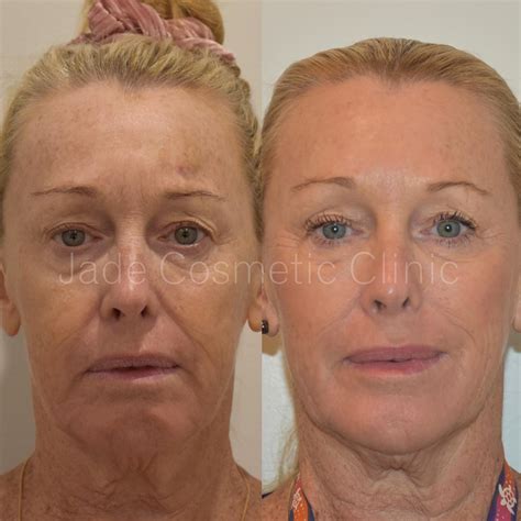 Dermal Fillers In Cairns Brisbane And Trinity Beach