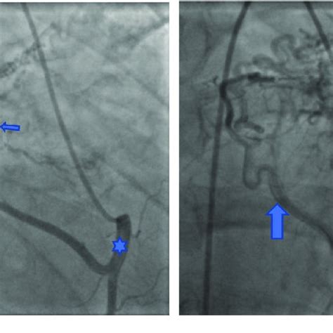 A B Left Heart Catheterization Femoral Approach Right Anterior