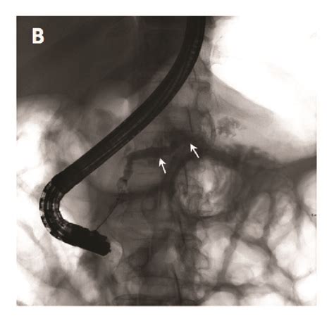 Ercp At Admission A Shows Mild Diffuse Dilatation Of Ventral