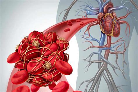When a blood vessel (a vein or an artery) is injured, the body uses platelets. Trombosis / Coágulo sanguíneo - Punta Mita Hospital