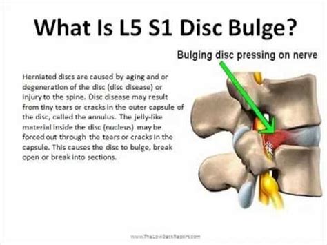 Yoga For Bulging Disc L5 S1 Blog Dandk