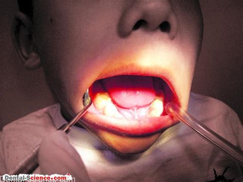 Management Of Children With Hypersensitive Gagging Reflex Dental Science